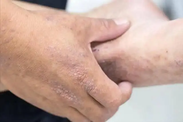 皮肤糖化表现_糖化肌肤改善_糖化对皮肤的影响
