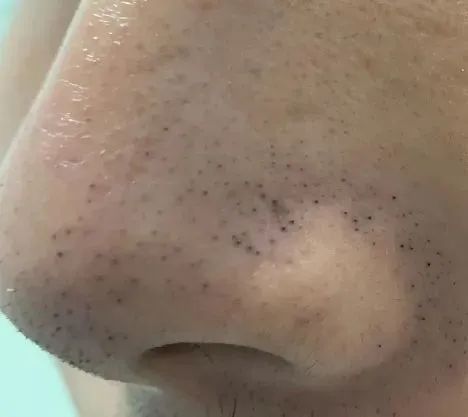 黑头粉刺与黑头的区别_黑头形成原因分类处理方法_黑头导出清洁