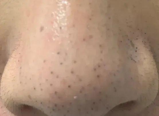 黑头导出清洁_黑头形成原因分类处理方法_黑头粉刺与黑头的区别